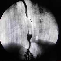 裂孔疝和返流性食管炎可同时