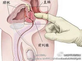 前列腺快感指男性前列腺受到适度刺激后产生的性快感