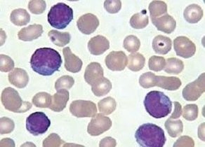 异型淋巴细胞_360百科