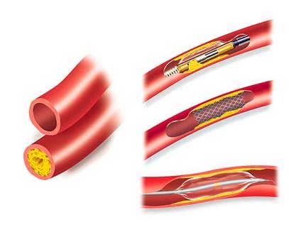 血管支架_360百科