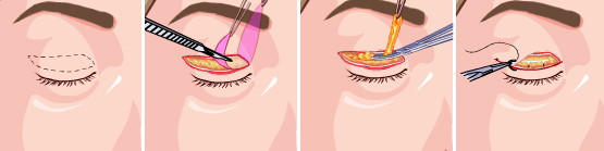 一类为肌原性因素:重症肌无力时可能仅仅表现